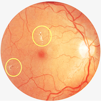 Diabetic maculopathy