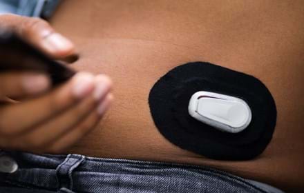 Dexcom Glucose Monitor On A Person