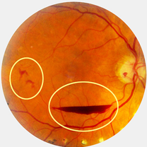 Proliferative diabetic retinopathy