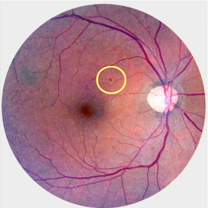 Background diabetic retinopathy