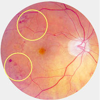 Pre-proliferative retinopathy