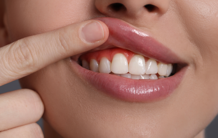 Gum Health Thumbnail